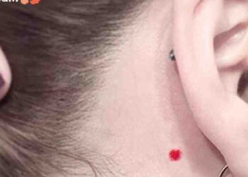 Hình ảnh về nốt ruồi son cho bạn hiểu rõ hơn