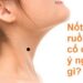 Tổng quan về nốt ruồi ở cổ