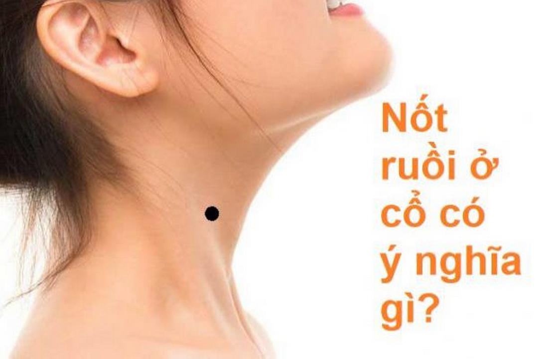 Tổng quan về nốt ruồi ở cổ