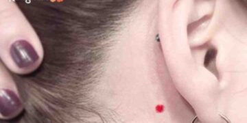 Hình ảnh về nốt ruồi son cho bạn hiểu rõ hơn