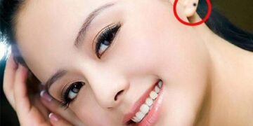 Nốt ruồi ở tai nói lên nhiều điều về con người