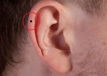 Nốt ruồi ở vành tai đàn ông bên phải tai trái nói lên điều gì