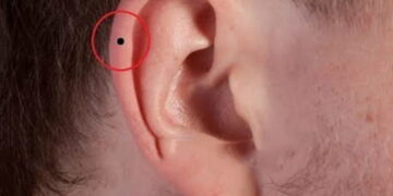 Nốt ruồi ở vành tai đàn ông bên phải tai trái nói lên điều gì