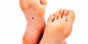 Nốt ruồi ở chân: giải mã về tình duyên, tài lộc, vận mệnh