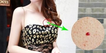 Nốt ruồi son ở ngực phụ nữ là giàu sang – Đào hoa ?