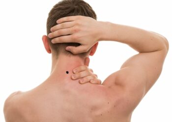 nốt ruồi phía sau cổ