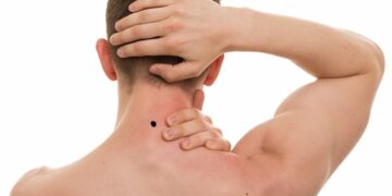 nốt ruồi phía sau cổ