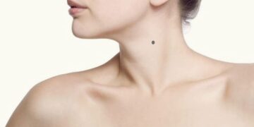 nốt ruồi ở cổ phải của nữ
